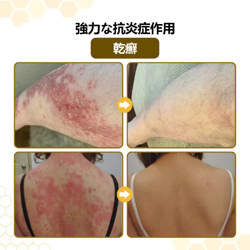 CleraNature® PsoriaSoothe 蜂毒配合スキンリジェネレーティングクリーム